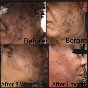 Acne Anti-Aging Gold Soap